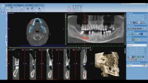 Planmeca implant planning in Romexis Viewer