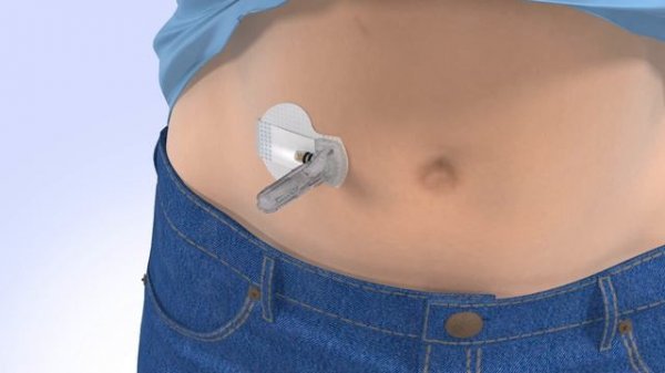 Inserting the Guardian™ Sensor 3 with the MiniMed™ 670G System