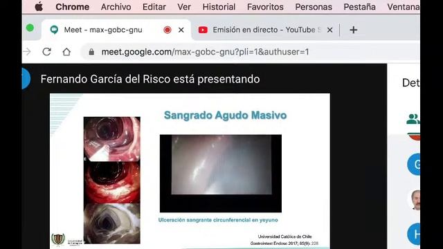 Interés de la cápsula endoscópica en el sangrado de intestino medio. Dr. Fernando Garcia del Risco смотреть онлайн
