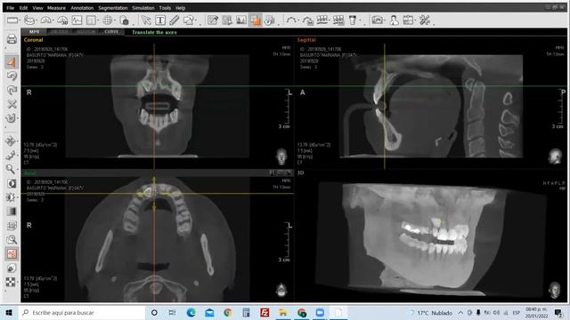 3er Webinar dental "“Manejo de software de Tomografía Cone Beam para el diagnóstico odontológico" смотреть онлайн