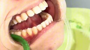 Как устанавливают брекеты?