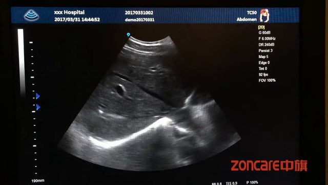Zoncare Q3 -Full digital color doppler Ultrasound system смотреть онлайн