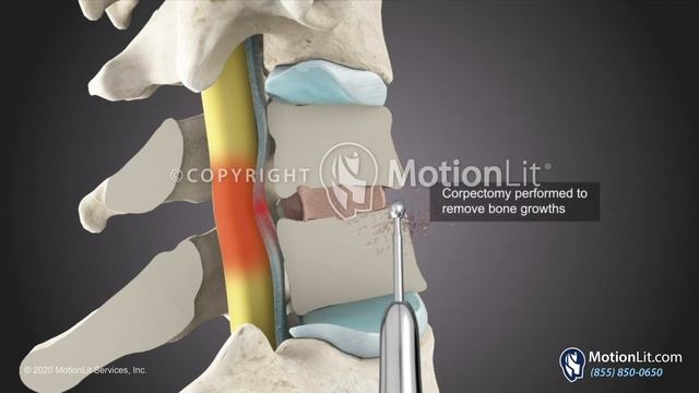 3D Surgery Animation Portrays Cervical Spine Revisions смотреть онлайн