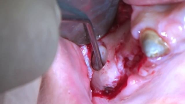 Piezosurgery Open Window Sinus Lift смотреть онлайн