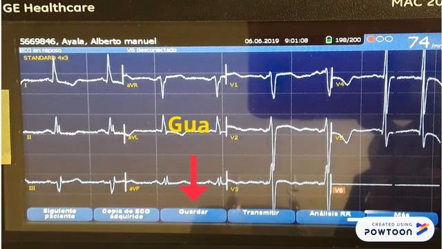 ECG GE MAC 2000 смотреть онлайн