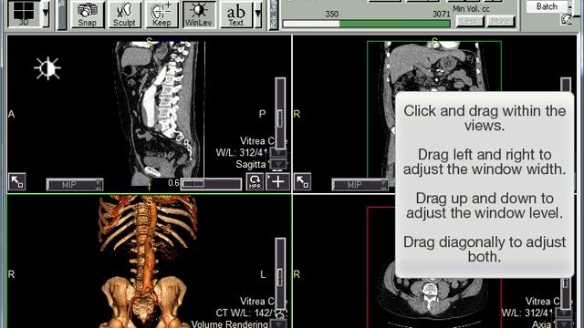 Vitrea Core Window Level Demo смотреть онлайн