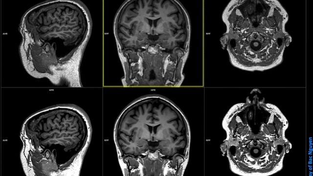 MR Neuro Imaging - MPRAGE @ Siemens 3T смотреть онлайн