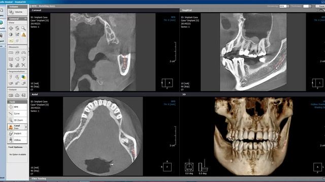 Xelis Dental - How to Trace Mandibular Nerve Canal v2 смотреть онлайн