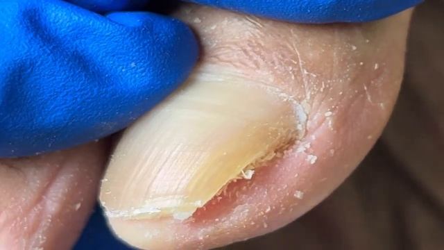 Nail Trimming_ Extra Long Nails Are Like A Sickle【Xue Yidao Pedicure】