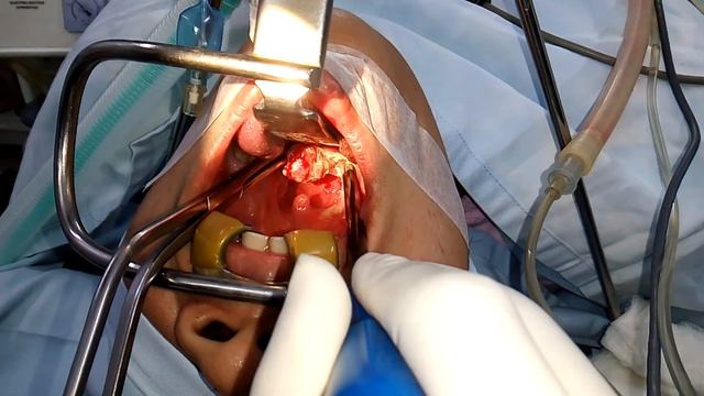 Coblation Tonsillectomy -by Dr.Nurul Huda Nayeem at NJL ENT Centre смотреть онлайн