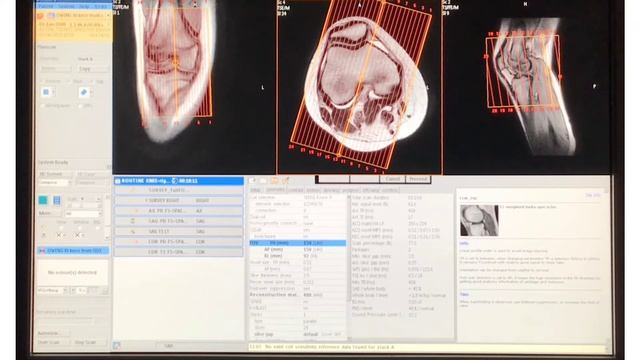 MRI Knee / lower leg set up Week 10 смотреть онлайн
