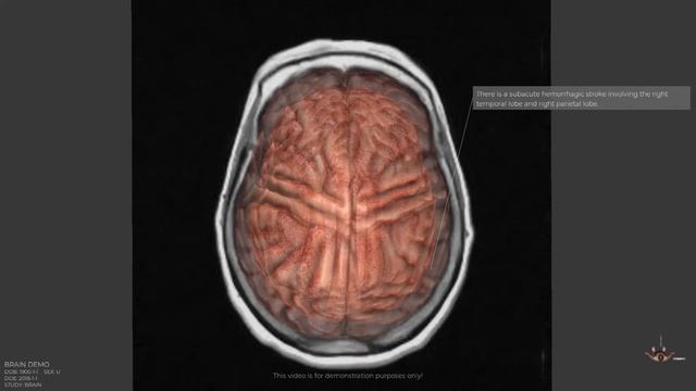 3D MRI Rendering - Brain смотреть онлайн