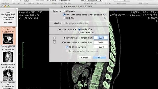 Generating 3D models using Osirix смотреть онлайн