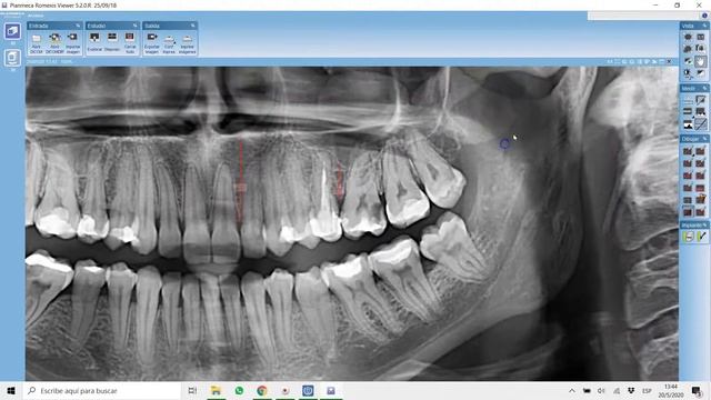 RADIOGRAFIA PANORAMICA EN ROMEXIS VIEWER смотреть онлайн
