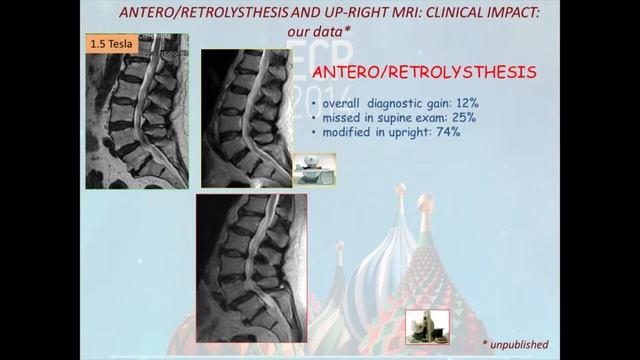Up-right MRI of the lumbo-sacral spine: 10 years after смотреть онлайн