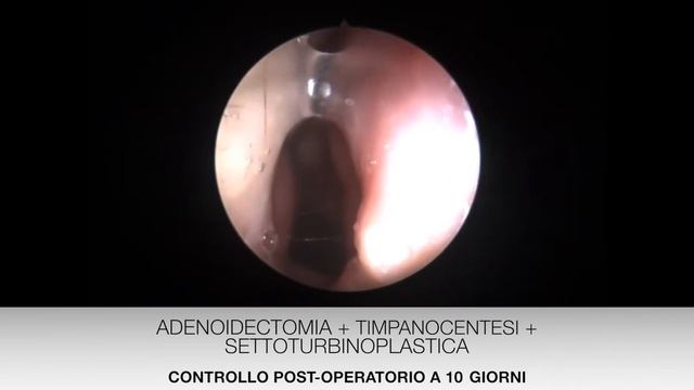 Chirurgia del setto nel bambino: intervento sicuro ed efficace. смотреть онлайн