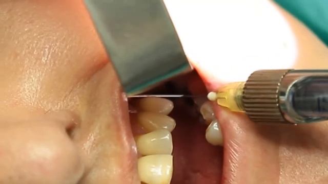 Dental Implantation with Endoscopic Visualization Karl Storz. Professor Orlov смотреть онлайн