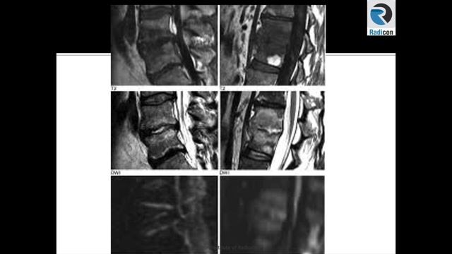 Lumbar Spine MRI Part 13: Discitis and DWI смотреть онлайн