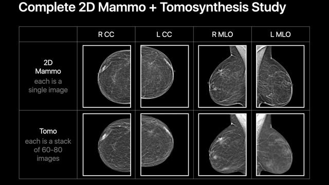Mammography & Tomosynthesis Basics