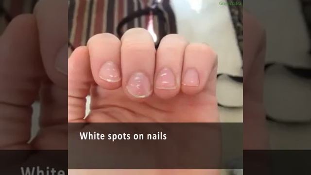 Nails And Nail Beds: Windows to Health or Disease? смотреть онлайн