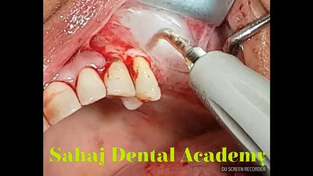 Direct Sinus Elevation : Window with A View смотреть онлайн