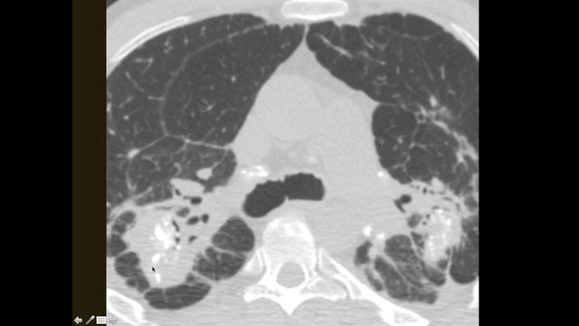 Imaging in Occupational disease смотреть онлайн