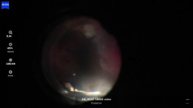 Iatrogenic eye смотреть онлайн