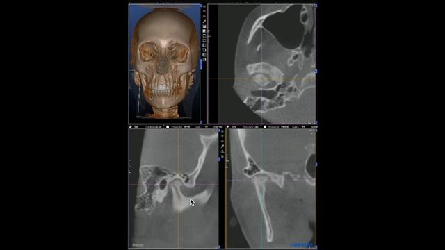 Navegação Dicom em Crânio Total - Viewer e-Vol смотреть онлайн
