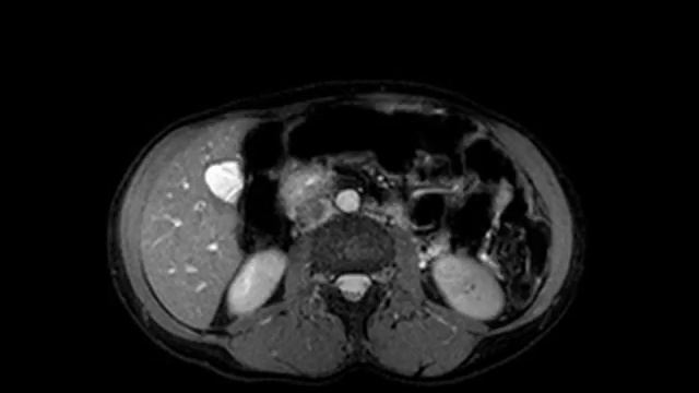 Liver MRI Part 3 смотреть онлайн