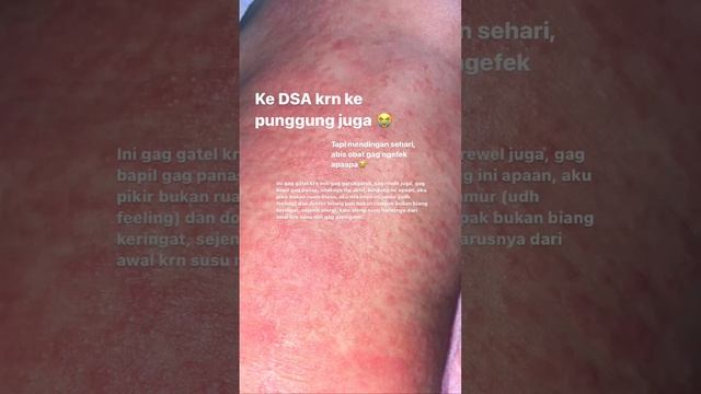 RUAM POPOK & JAMUR PADA BAYI #ruampopok #jamurpadabayi #alergi #dermatitis смотреть онлайн