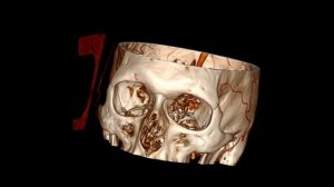 RadiAnt DICOM Viewer - Volume Rendering Preview