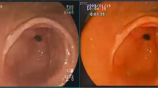 Greentel's endoscopy video enhancer & roentgenology//improvement of image quality/enhancement смотреть онлайн