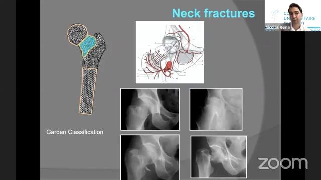 Fracture of the lower limb in adult Part 1 9 7 2022 смотреть онлайн