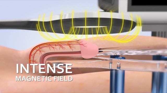 Erectile Dysfunction Shockwave Therapy, Electromagnetic Transduction, Tesla Chair & NanoVi Exo смотреть онлайн