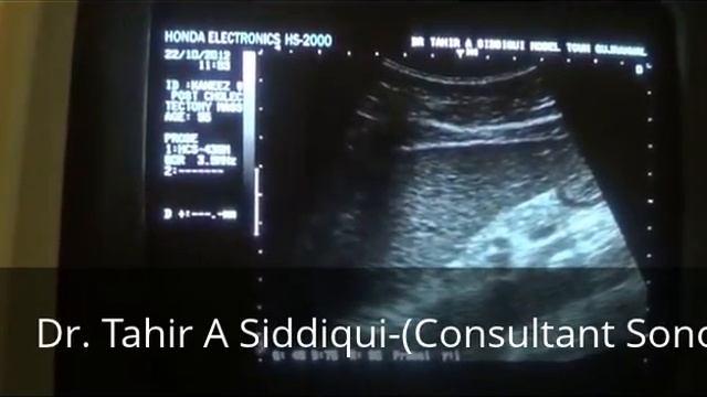 Solid subcutaneous MASSES with DILATED SLUDGE FILLD-CBD смотреть онлайн
