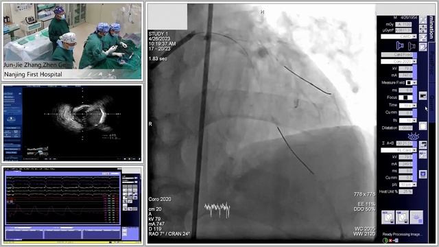 IVUS Guided PCI of LAD/D1 Bifurcation using DK Crush Technique смотреть онлайн