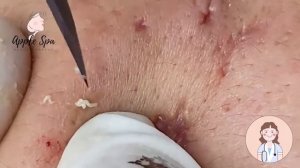 Relax every day with Apple Spa - Squeeze acne blackheads #47