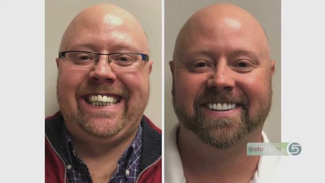 Replace Your Missing Teeth with Permanent Dental Implants смотреть онлайн