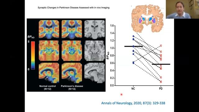 APDA CT 2021 Parkinson's Webinar: The Use of Brain Imaging in PD Research with Dr. Sule Tinaz смотреть онлайн