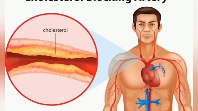 HOw does high cholesterol harm your legs /10 sign of cholesterol damage to the legs/ Umme hani mon смотреть онлайн