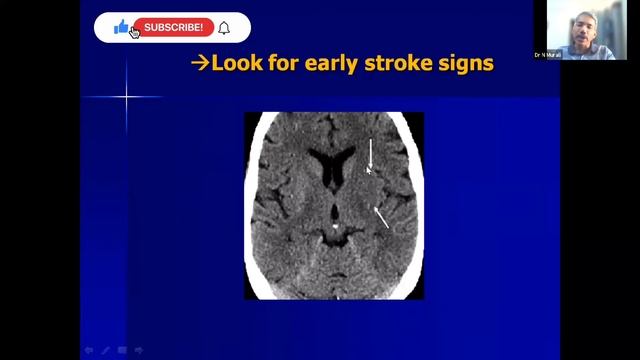 Acute stroke imaging in ct scan | celebrating international day of radiology смотреть онлайн