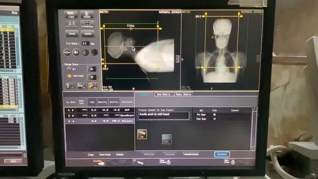 CT NECK ANGIO FULL PROCESS IN HINDI смотреть онлайн