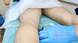 Пункция кисты Бейкера под контролем УЗИ