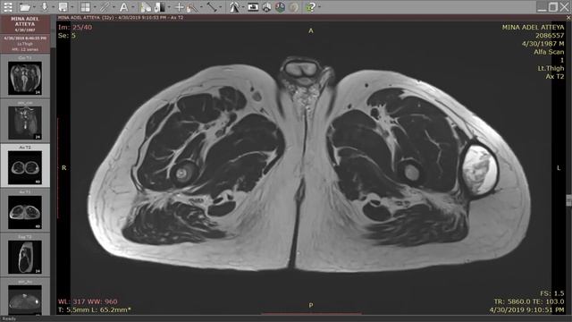 8-Anatomy of the TMJ and thigh muscles смотреть онлайн