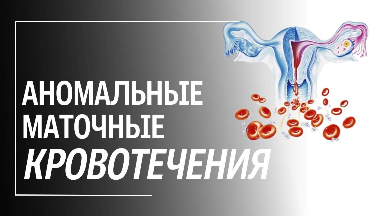 Аномальное маточное кровотечение: причины, диагностика, лечение. смотреть онлайн