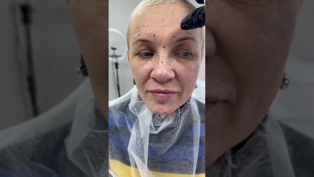 Ботокс до после смотреть онлайн