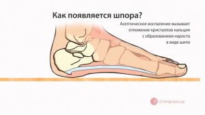 Что такое пяточная шпора?