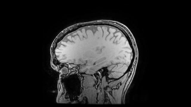 MRA - Brain venous flow (T1 sagittal, 3 tesla, no contrast) [low compression, 60fps] смотреть онлайн
