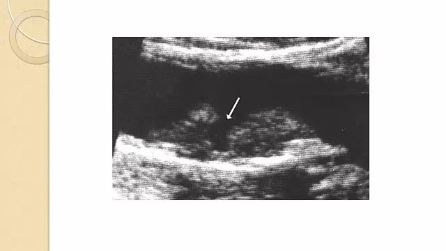 Carotid pathology Dr,Hateem El Azize смотреть онлайн