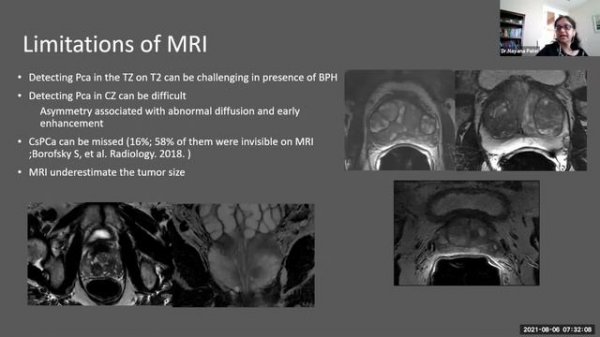 Prostate MRI
